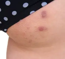 Pryszcze na nogach: przyczyny, leczenie i jak się ich pozbyć