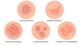 Ilustracja pokazuje różne rodzaje łuszczycy, w tym łuszczycę plackowatą, odwróconą, krostkową, kropelkowatą i erytrodermię łuszczycową. To pierwsze objawy tej choroby skóry.