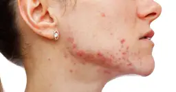 Jak pozbyć się pryszcza w 1 noc? Skuteczne triki Izabeli M.