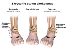 Objawy skręcenia: jak rozpoznać poważne kontuzje stawów