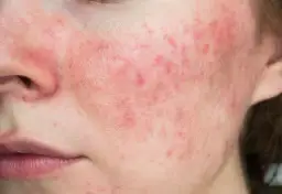 Trądzik różowaty przyczyny: Co wywołuje tę uciążliwą chorobę?