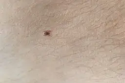 Kleszcz czy pieprzyk? Sprawdź, zanim spanikujesz! Ekspert radzi