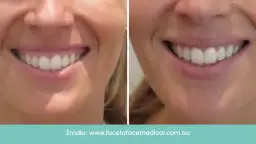 Czy Twoje dziąsła rosną? Rozpoznaj przerost i zadbaj o uśmiech