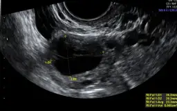 USG po owulacji co widać: kluczowe zmiany w jajnikach i macicy