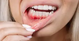 Krwawiące dziąsła: co oznaczają i jak skutecznie je leczyć?