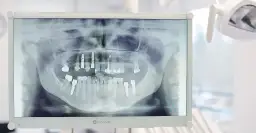 RTG zęba: Co naprawdę widzi dentysta? Ukryta próchnica i torbiele