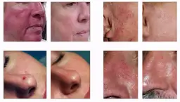 Skutki uboczne laserowego zamykania naczynek - co warto wiedzieć?