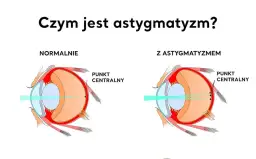 Astygmatyzm: Kiedy do okulisty, a kiedy do optometrysty?