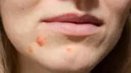 Rozdrapany pryszcz? Szybki ratunek, by zniknął bez śladu!