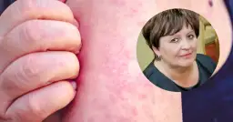 Dłoń drapiąca zaczerwienioną skórę z wysypką. W tle kobieta, być może cierpiąca na tę chorobę.