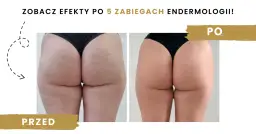 Endermologia: co to, jak działa i czy warto? Pełny przewodnik
