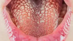 Białe krostki na języku: Jak rozpoznać i leczyć białe krostki na języku?