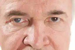 Najważniejsze objawy jaskry - poznaj oznaki tej groźnej choroby oczu