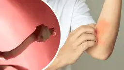 Niepokojące objawy tasiemca u człowieka: lista najważniejszych symptomów