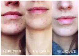 Skutki uboczne odstawienia antykoncepcji: co musisz wiedzieć o objawach