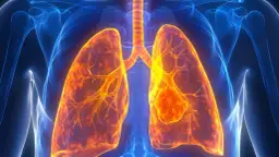 Guz w płucach: Co oznaczają guzy w płucach?