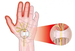 Naciągnięte ścięgno ręki: 7 objawów, które nie mogą Cię zmylić
