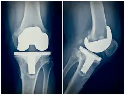 Jakie badania przed endoprotezą kolana? Lista i zalecenia przed operacją