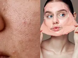 Jak wygląda zapchana cera? Poznaj objawy i sposoby leczenia