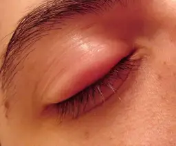 Obrzęk jednej powieki górnej: najważniejsze przyczyny i objawy, które musisz znać