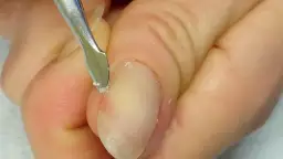 Jak obciąć skórki na paznokciach bez ryzyka uszkodzenia?