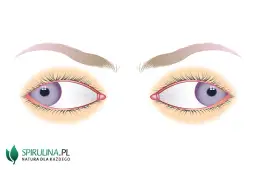 Co to jest zez rozbieżny? Objawy, przyczyny i skuteczne leczenie