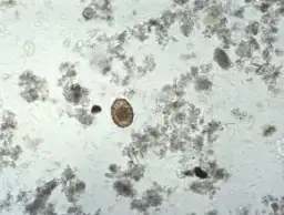 Tłuszcz w kale: Co oznacza i jak go rozpoznać? 6 ważnych wskazówek