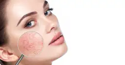 Jak skutecznie dbać o cerę naczynkową i uniknąć pogorszenia jej stanu