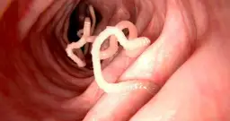 Bakteryjne i pasożytnicze choroby układu pokarmowego: Przegląd