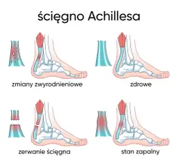 Najczęstsze objawy naciągnięcia ścięgna Achillesa: rozpoznaj kontuzję