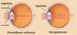 Czy astygmatyzm może się zmniejszyć? Poznaj prawdę o leczeniu i wieku