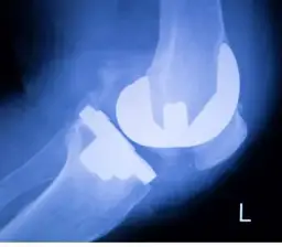 Kwas hialuronowy w kolano czy boli? Odkryj prawdę o bólu i skutkach