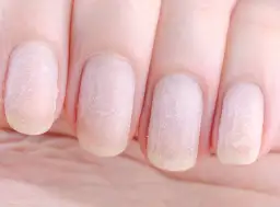 Uszkodzona macierz paznokcia: objawy, leczenie, regeneracja