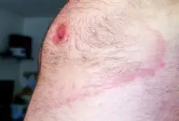 Czy rumień po kleszczu swędzi? Objawy, które musisz znać i kiedy iść do lekarza