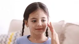 Skuteczne sposoby na ospę dla dziecka - jak złagodzić wszystkie objawy