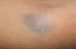 Skutki uboczne po wenflonie – poznaj poważne komplikacje i objawy