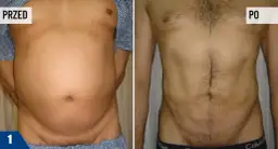 Liposukcja: Czy boli? Bezbolesny zabieg, kontrolowany dyskomfort