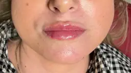 Dlaczego nie można palić po powiększaniu ust? Ważne powody i ryzyka