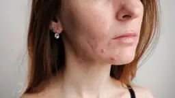 Blizny po pryszczach? Skuteczne metody na gładką cerę i jak im zapobiegać