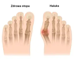 Ból haluksa: dlaczego stopa cierpi i jak znaleźć ulgę?