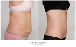 Liposukcja brzucha: Co to jest, dla kogo, efekty i cena?