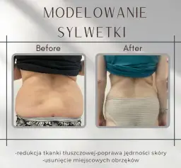 Liposukcja: co to? Modelowanie sylwetki, metody, ceny ekspert radzi