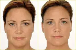 Zmarszczki palacza: Botox czy kwas hialuronowy - co wybrać?