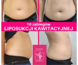 Ile zabiegów liposukcji kawitacyjnej? Odkryj swój plan!