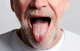 Medikamente gegen Mundsoor: Effektive Lösungen für schnelle Linderung