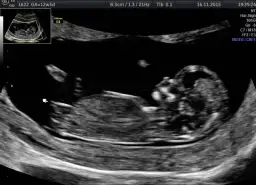 Jak wyglądają badania prenatalne w 13 tygodniu ciąży i co warto wiedzieć