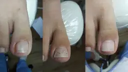 Klamra na paznokieć czy boli? Odkryj prawdę o bólu podczas zabiegu