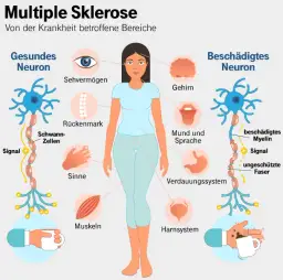 Plötzlich multiple Sklerose: Die häufigsten Symptome und Beschwerden