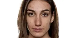 Skuteczne sposoby na czerwone plamy po pryszczach, które zadziałają