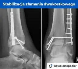 Złamana kość? Ile trwa rehabilitacja i jak wrócić do formy?